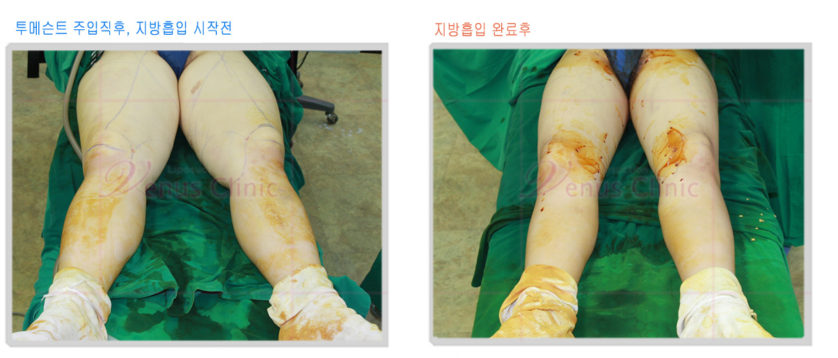 투메슨트(tumescent) 수액으로 투메슨스(tumescence)된 모습