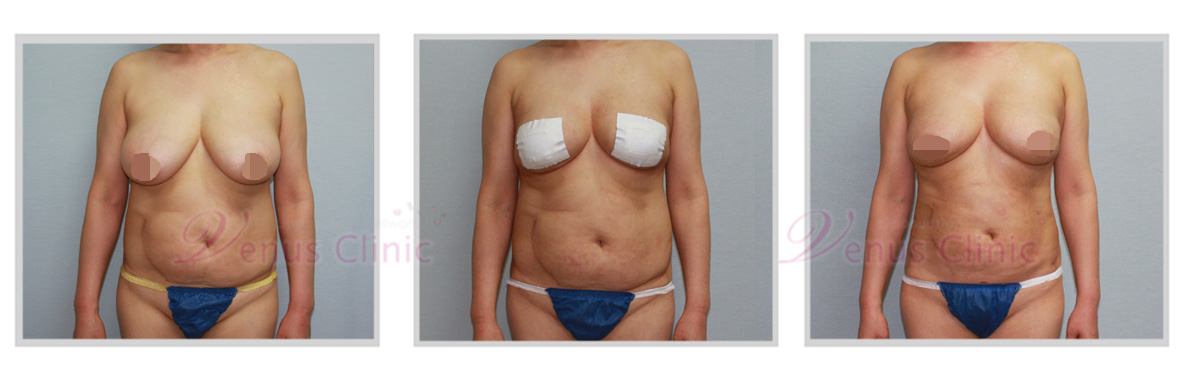 breast.jpg
