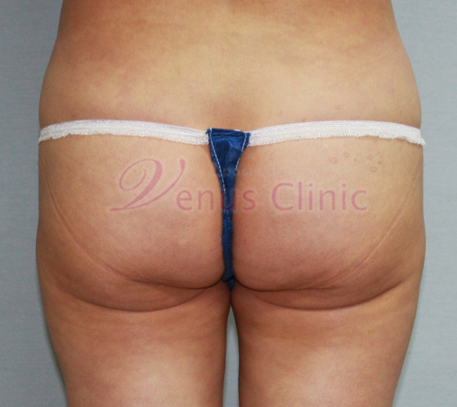 double_gluteal_line.jpg