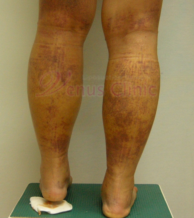 edema.jpg