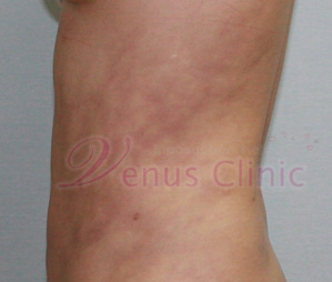 erythema_igne.jpg