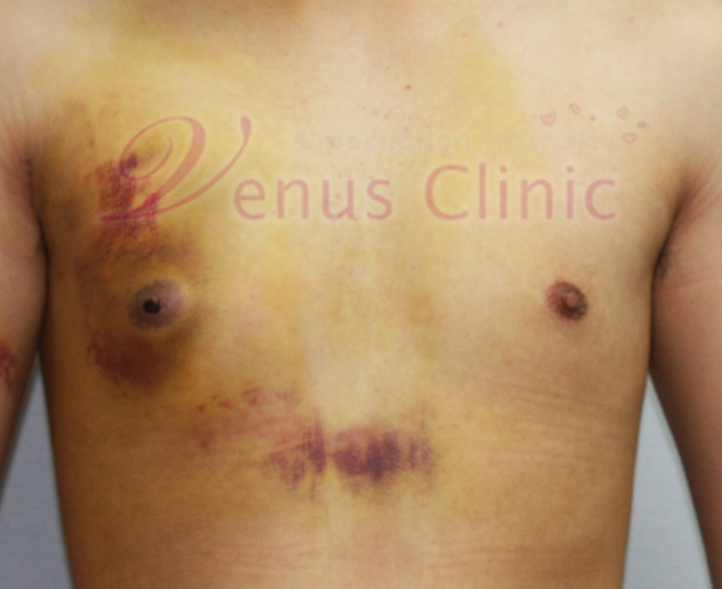 hematoma1.jpg