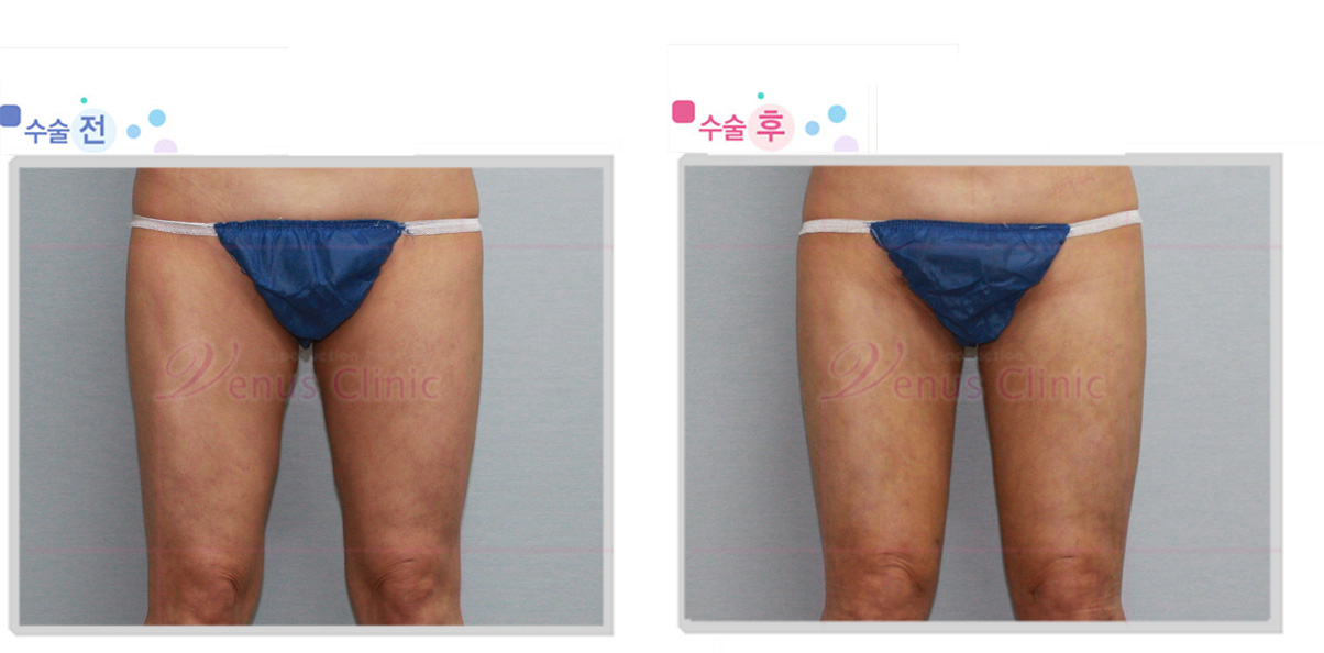 thigh.jpg