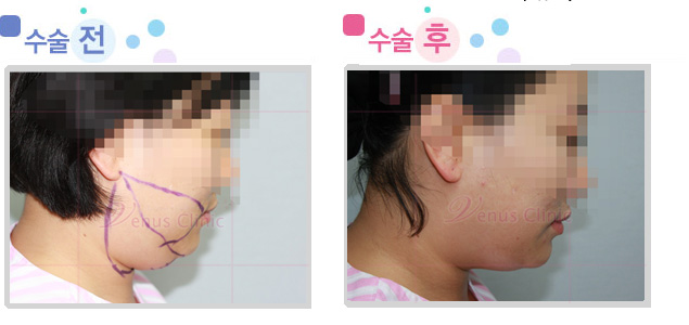 chin_cheek.jpg chin_cheek.jpg