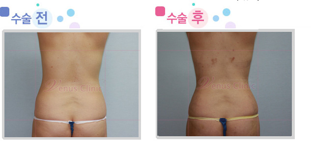 female_hip.jpg female_hip.jpg