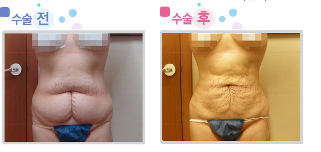 female_lower_abdomen.jpg female_lower_abdomen.jpg