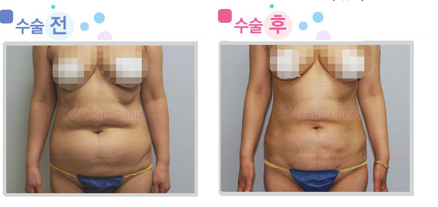 female_upper_abdomen.jpg female_upper_abdomen.jpg