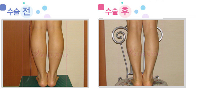 leg.jpg leg.jpg
