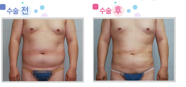 male_abdomen.jpg male_abdomen.jpg