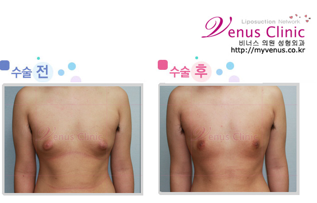 male_breast.jpg male_breast.jpg