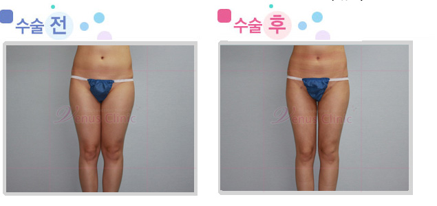 thigh_circumferential.jpg thigh_circumferential.jpg