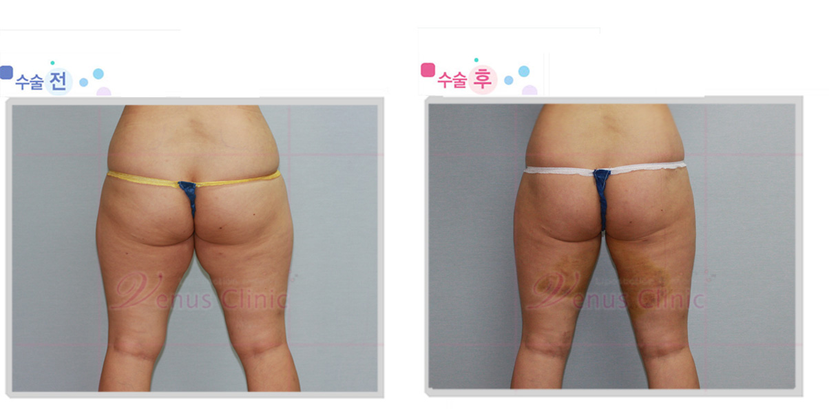 thigh_inner1.jpg thigh_inner1.jpg