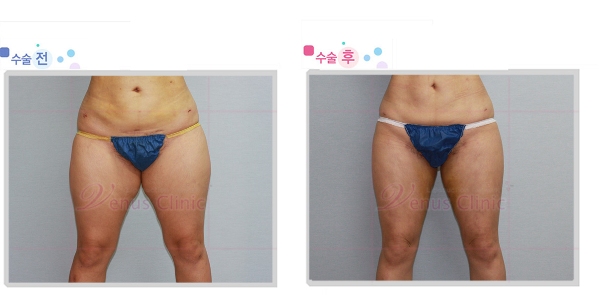 thigh_inner2.jpg