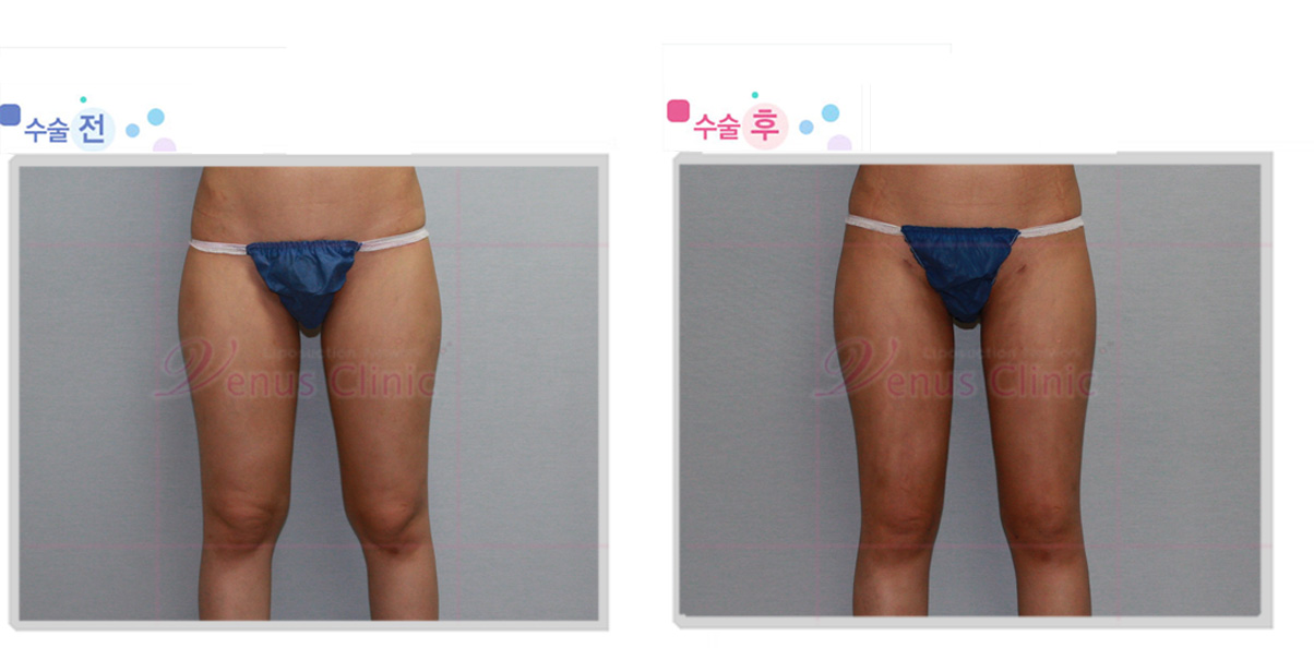 thigh_knee1.jpg