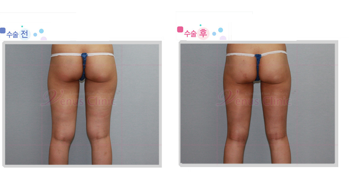 thigh_knee2.jpg