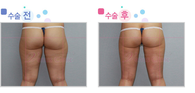 thigh_lateral.jpg thigh_lateral.jpg