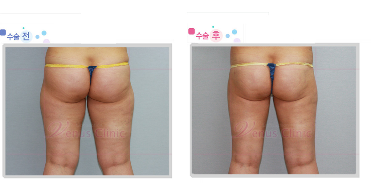 thigh_post.jpg
