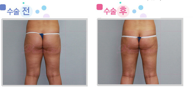 thigh_posterior.jpg thigh_posterior.jpg