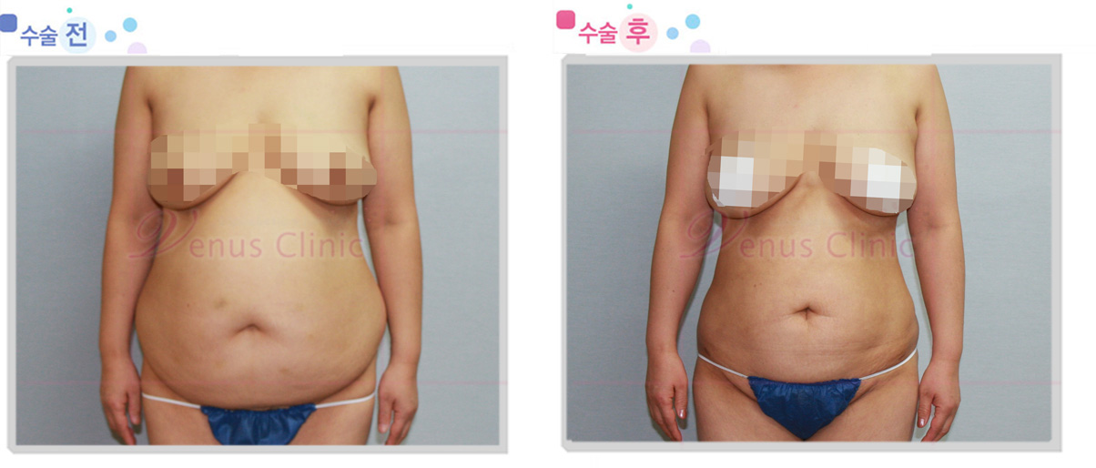 복부 대용량지방흡입 사진