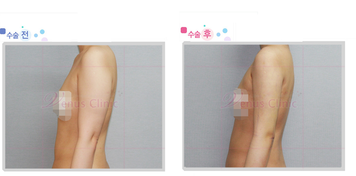 arm1_1wk.jpg