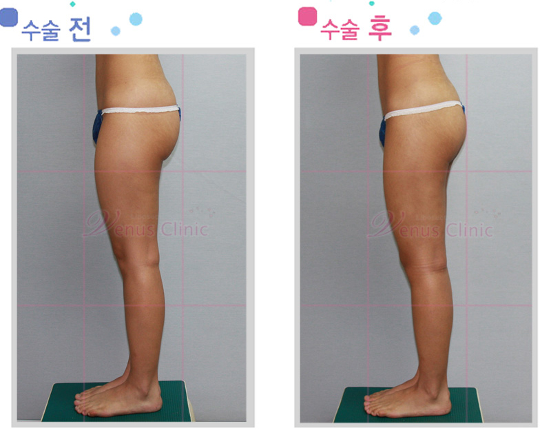 전체 허벅지 지방흡입 전후사진3