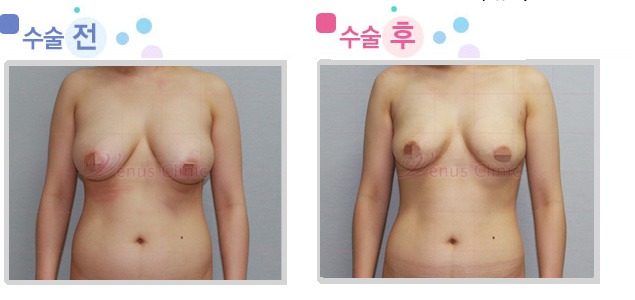 breast01_1.jpg