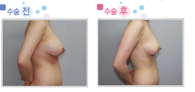 breast01_2.jpg