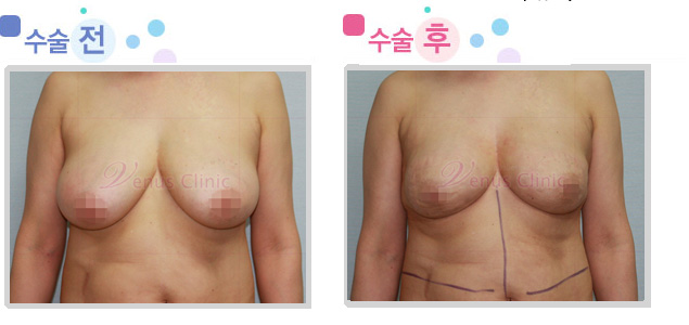 breast03_1.jpg