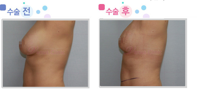 breast03_2.jpg