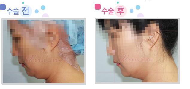 jaw02.jpg