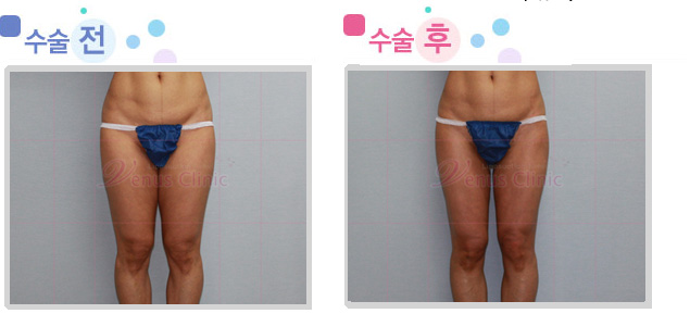 thigh01_1.jpg