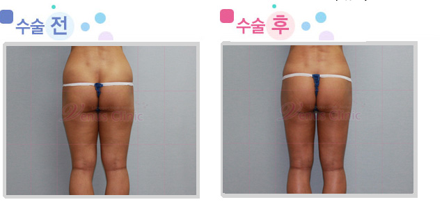 thigh01_2.jpg