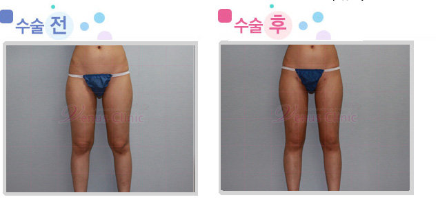 thigh02_1.jpg