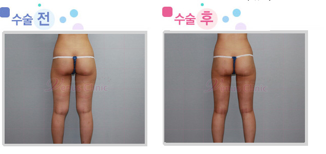 thigh02_2.jpg