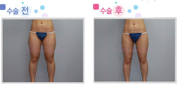 thigh03_1.jpg