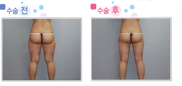 thigh03_2.jpg