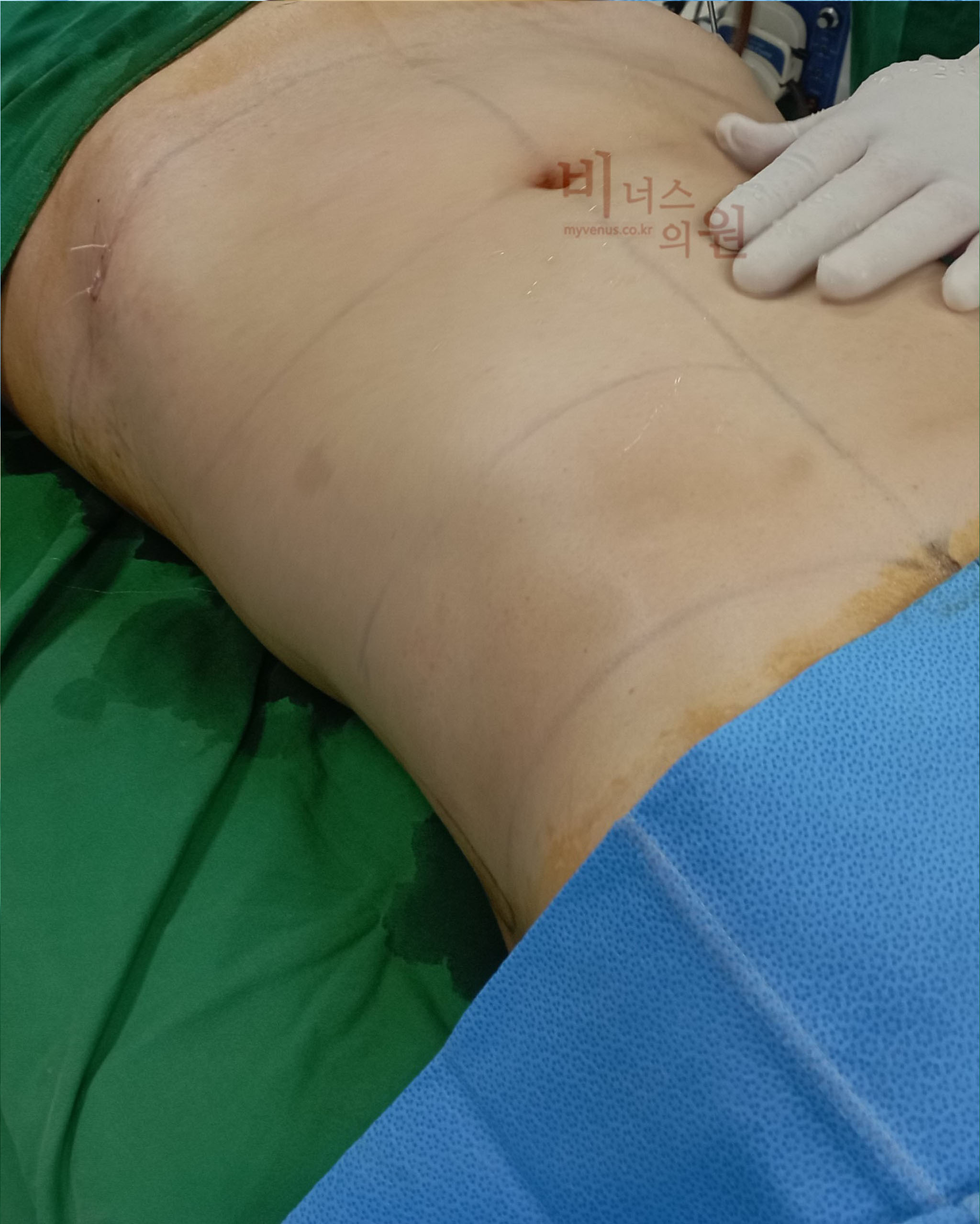 복부지방흡입 흉터.jpg