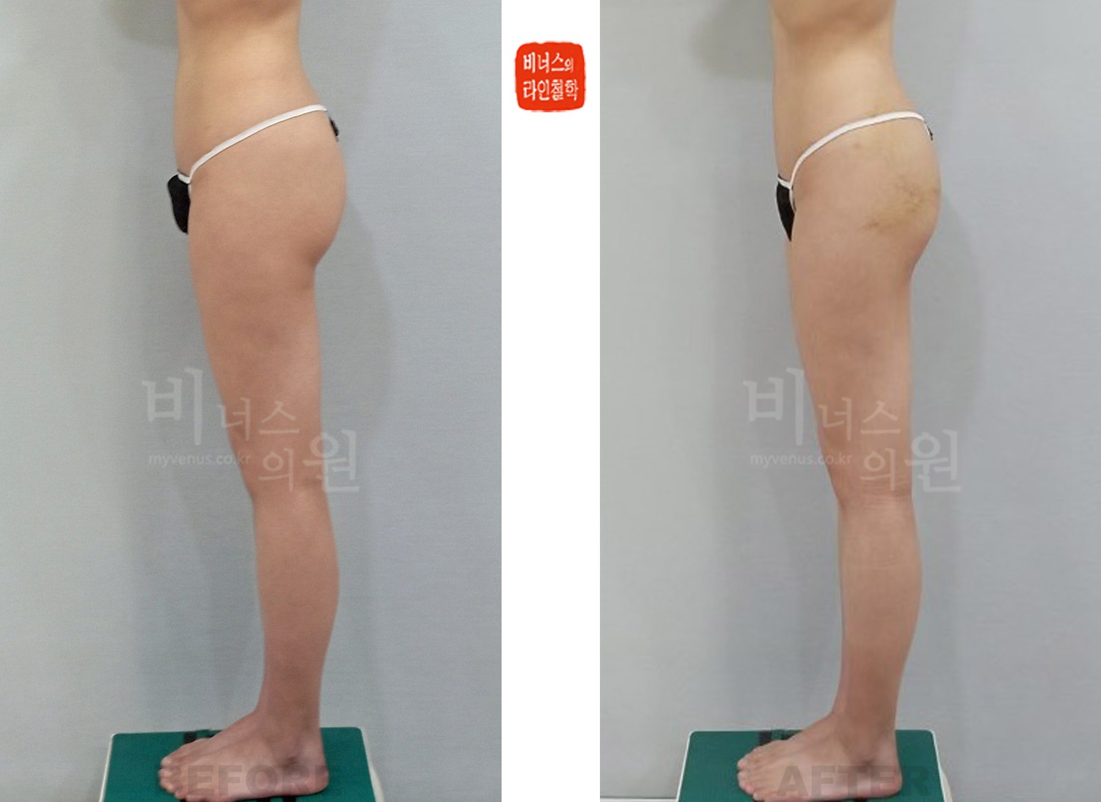 가로형으로 처진 엉덩이 지방흡입 전후사진 측면 (수술 후 1주일)
