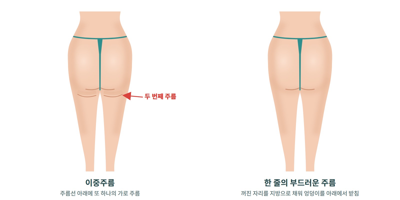 바나나 폴드와 이중주름 지방이식의 가상 전후 뒷모습
