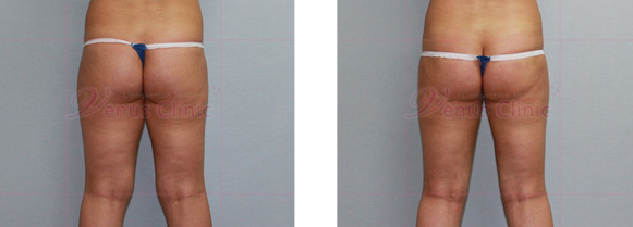 엉덩이 지방흡입 사진3