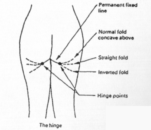 엉덩이 받침대 주름의 다양한 형태