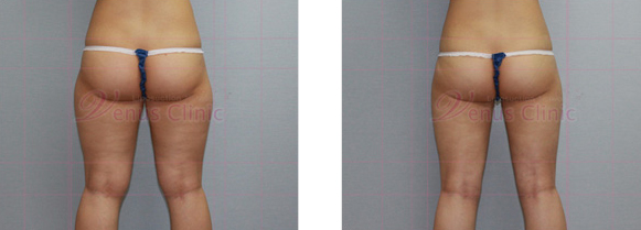 엉덩이 지방흡입 사진2