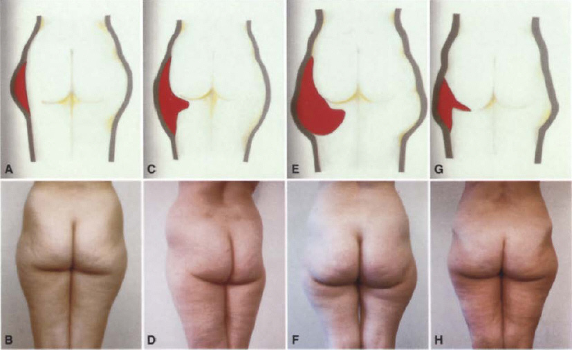 Gasparotti 의 saddle bag 분류