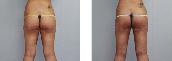 엉덩이 지방흡입 사진