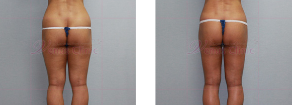 엉덩이 지방흡입 사진1