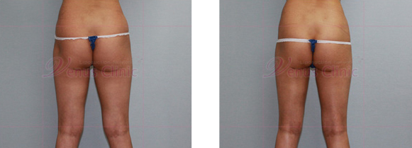 엉덩이 지방흡입 사진4