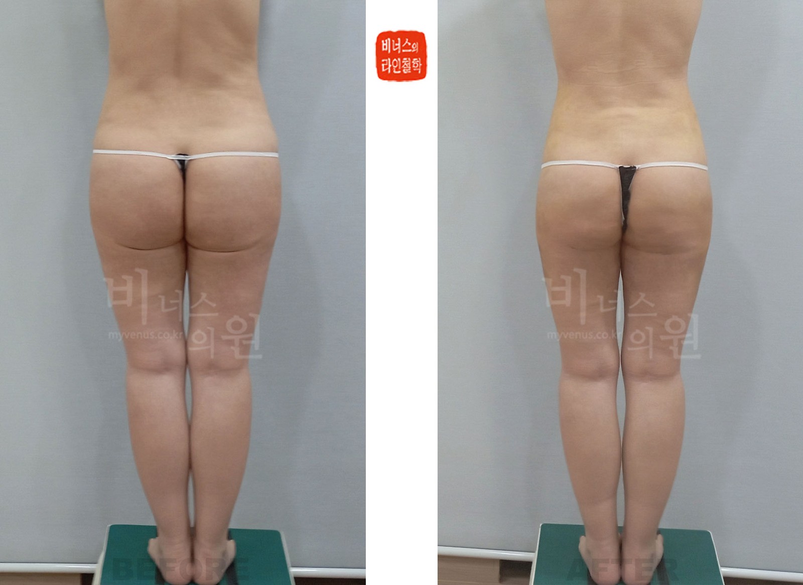 엉덩이·허벅지 지방흡입 재수술 전후사진 두 번째 케이스 후면