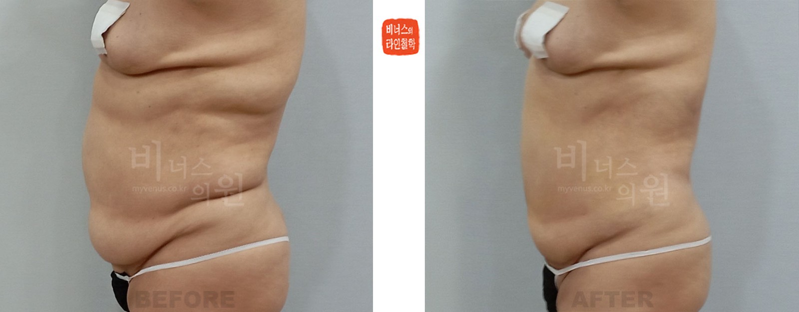 복부 지방흡입 재수술 전후사진 첫 번째 케이스 측면
