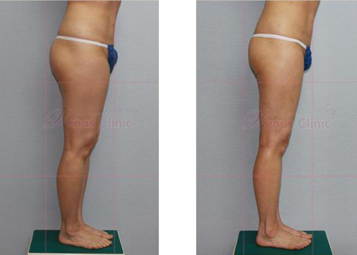 엉덩이 지방흡입 전후사진3