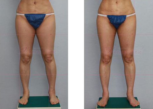 엉덩이 지방흡입 전후사진1